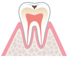 表面的な初期虫歯。