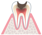 歯の神経まで虫歯が進んでる。