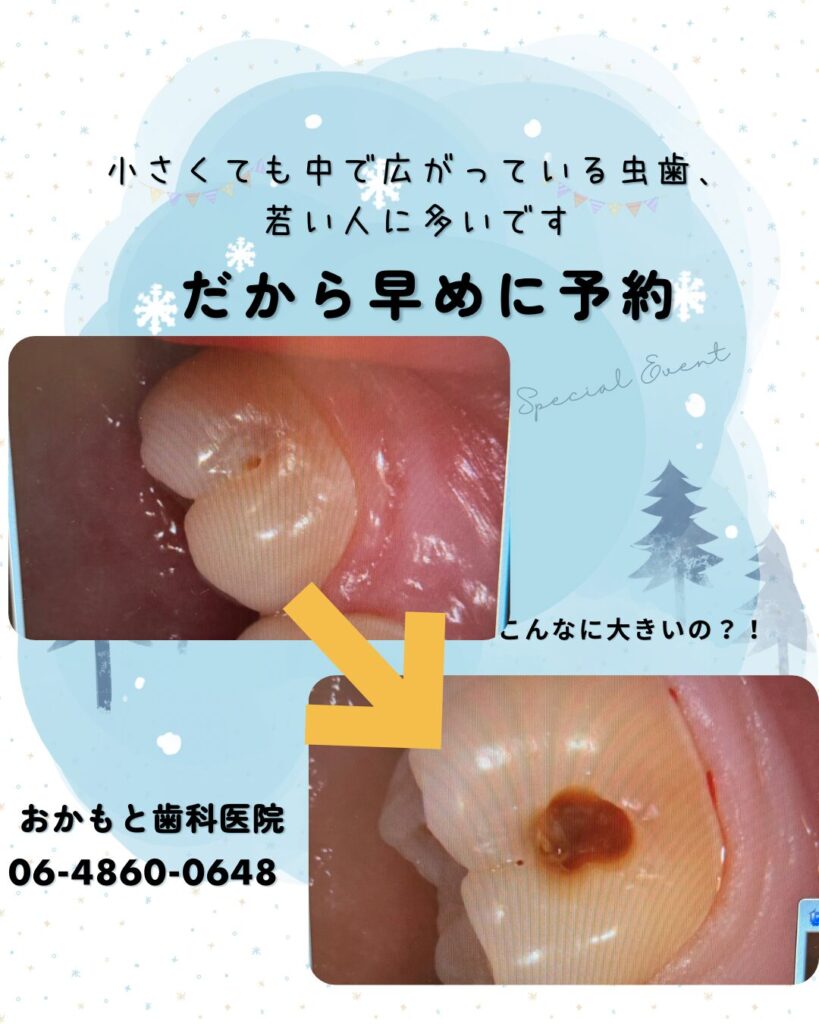 痛くない小さい虫歯も要注意