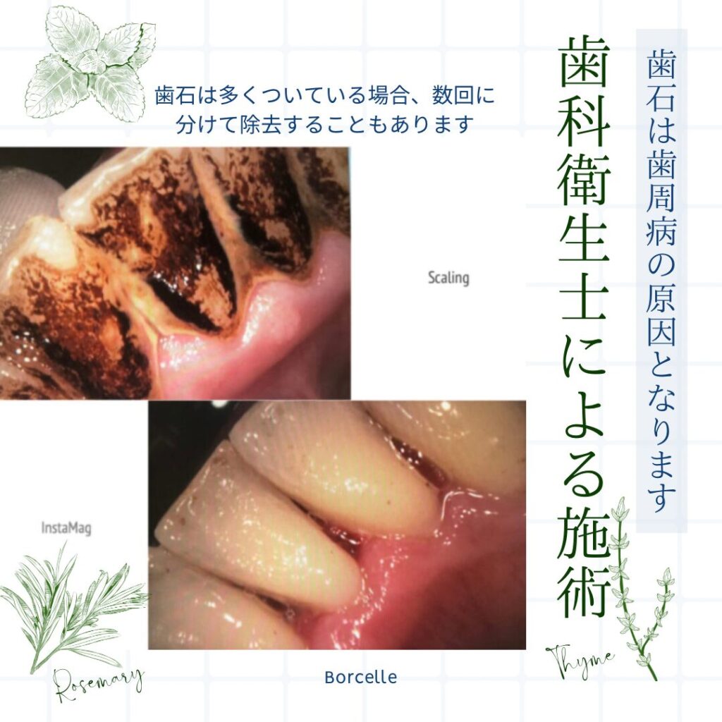 歯石や歯垢